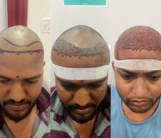 Hair Transplant - Real Results That