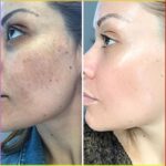Chemical Peel