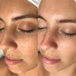 Chemical Peel