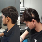 Hair Regrowth