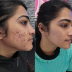 Chemical Peel