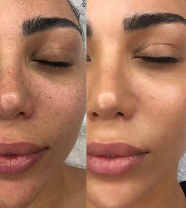 Hydra Facial Result