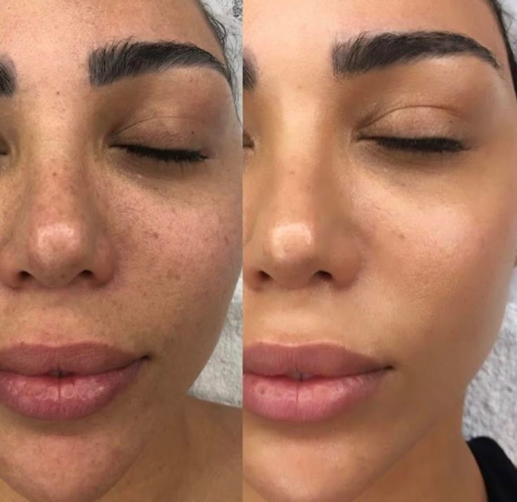 Hydra Facial Result