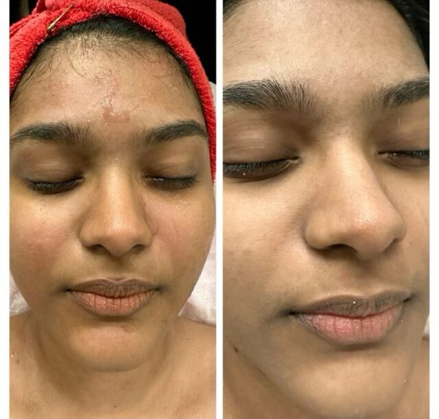 Hydra Facial Results Hydra Facial Results