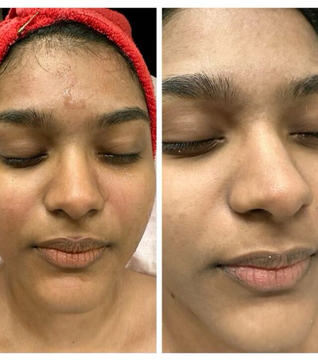 Hydra Facial Results