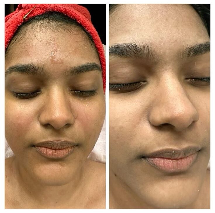 Hydra Facial Results