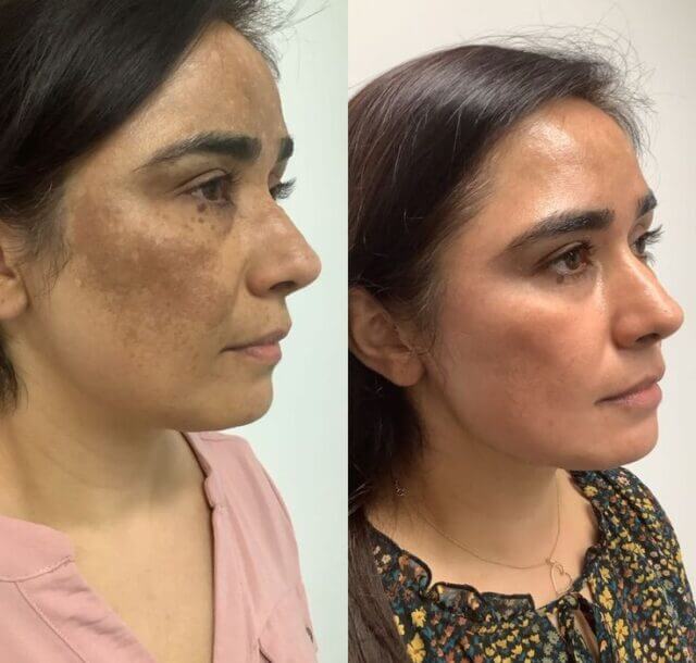 Peel Treatment Peel Treatment