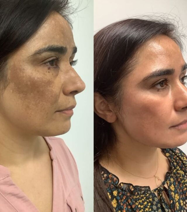 Peel Treatment