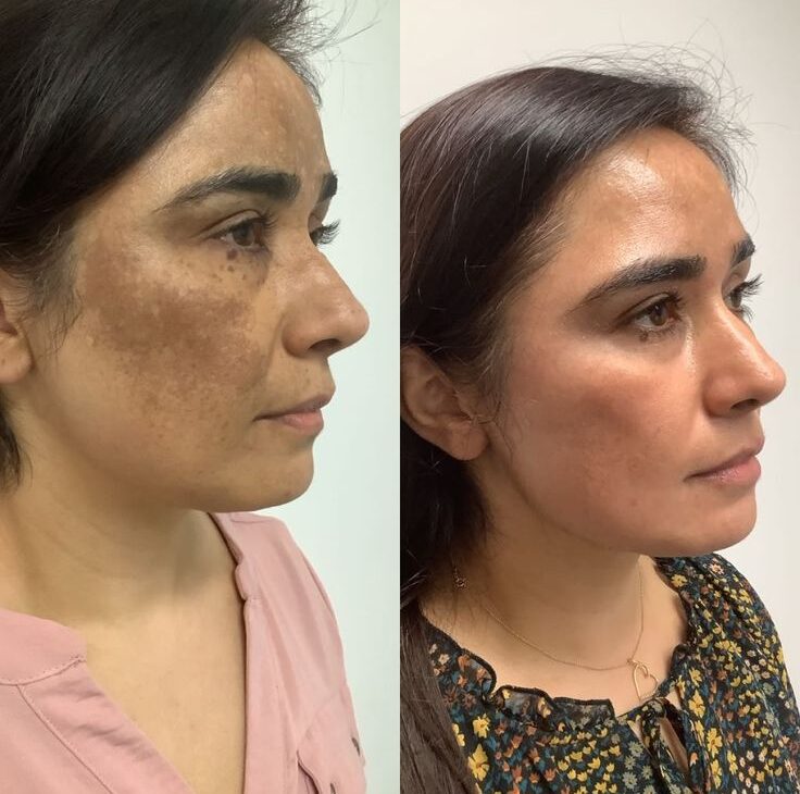 Peel Treatment