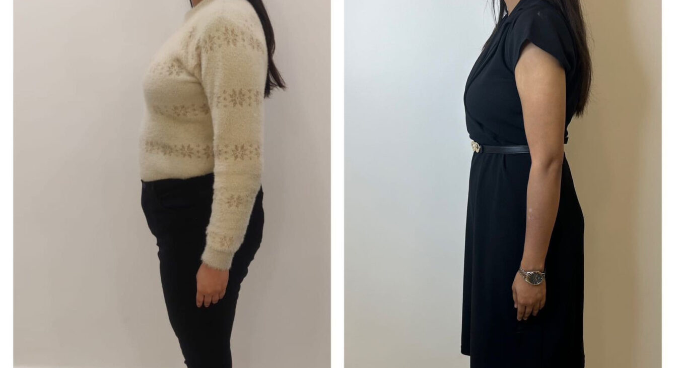 Weight loss B-A