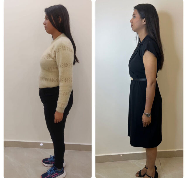 Weight loss B-A