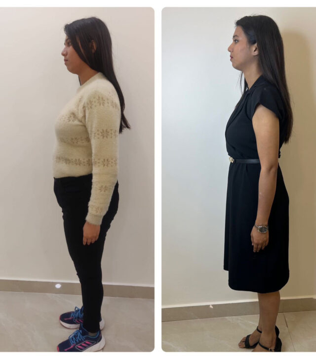 Weight loss B-A