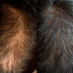 Hair Regrowth