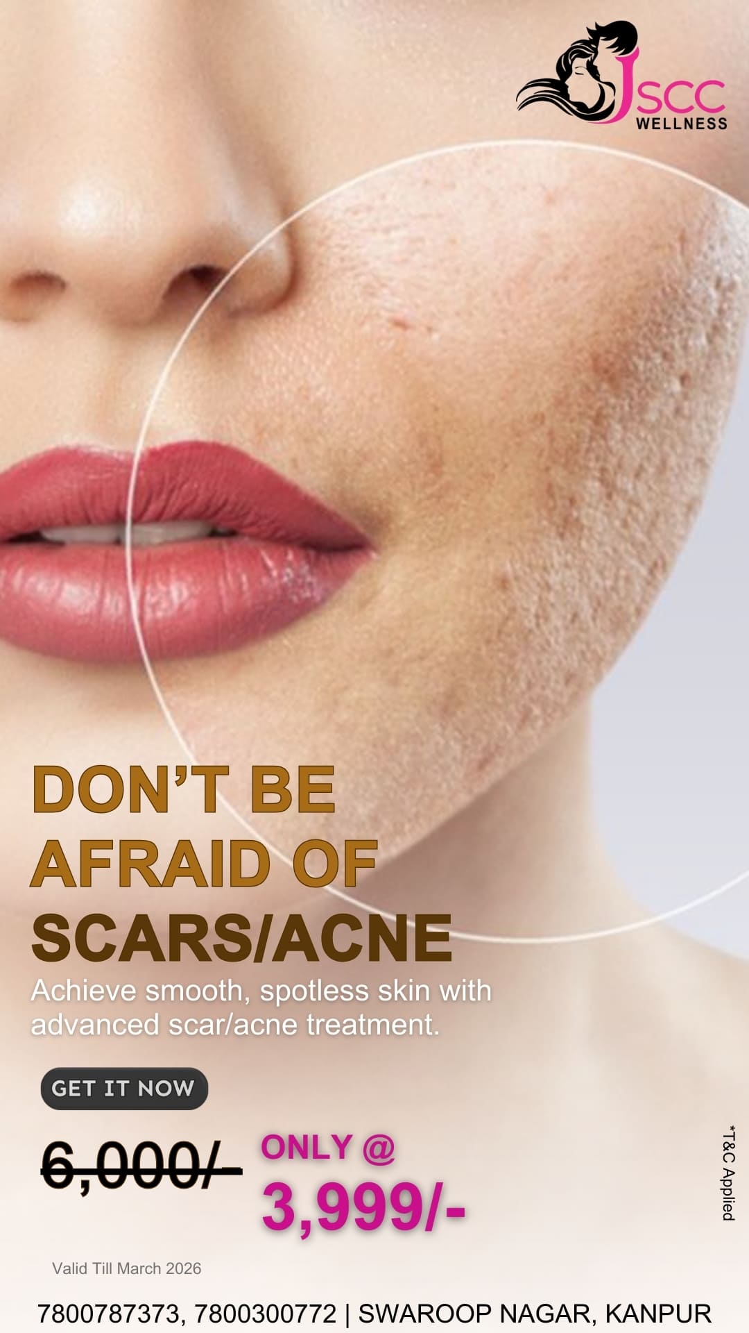 SCARS/ ACNE Treatment