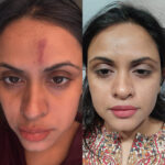 MNRF Treatment