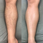 Hair Removal
