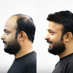Hair Regrowth