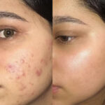 Chemical Peel