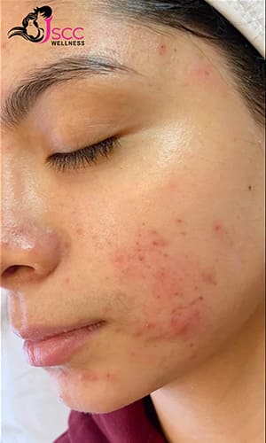 PRP Therapy